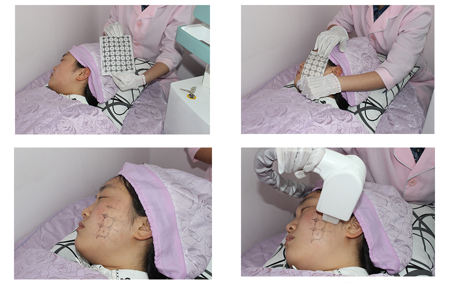 Thermage Fractional RF anti-aging device