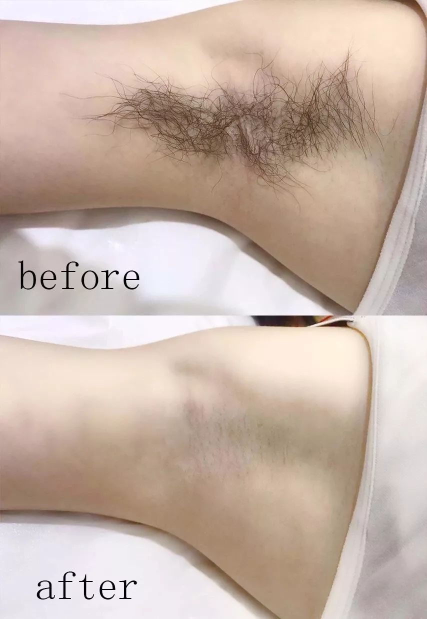 How to quickly remove hair？